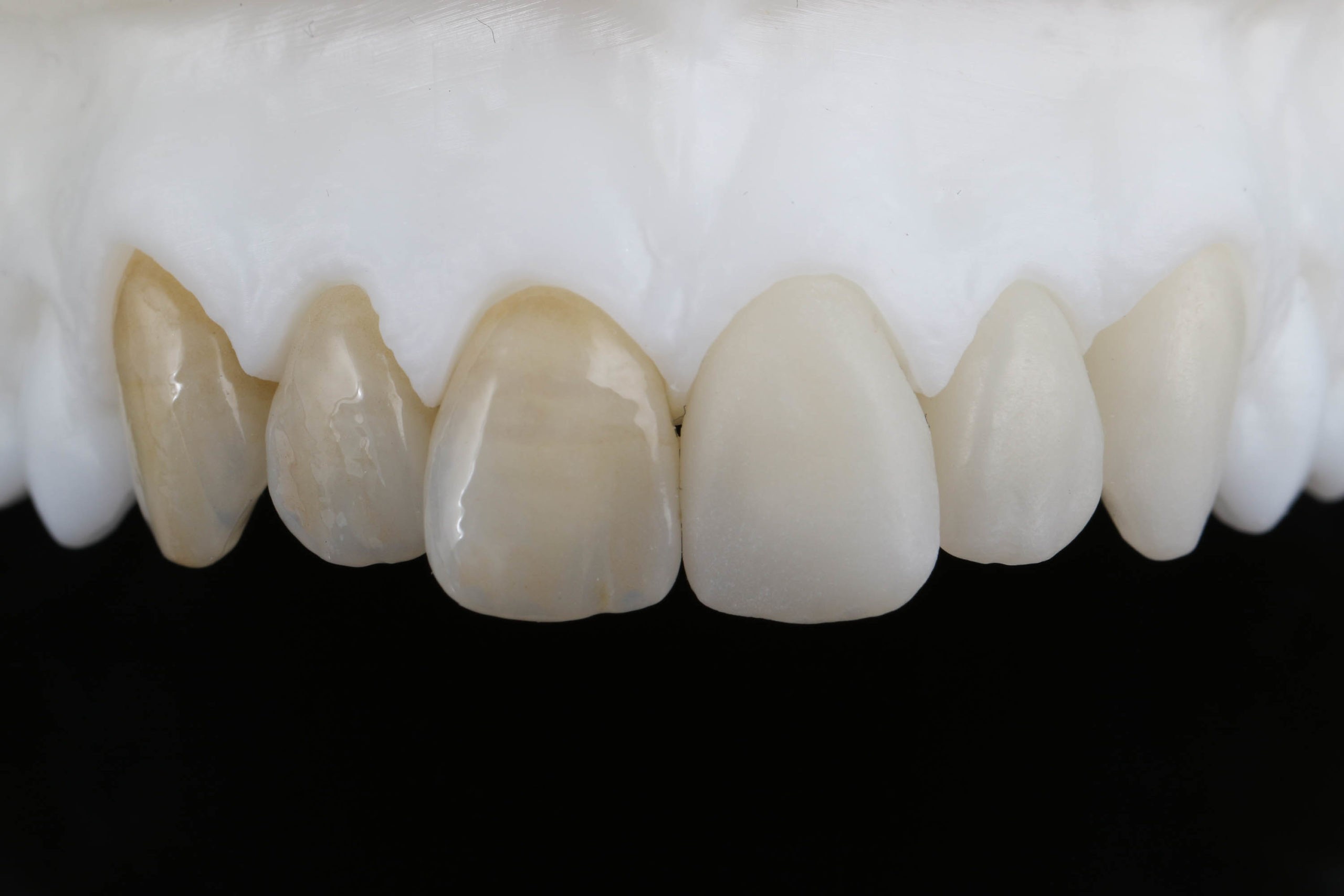 Zirlux Anterior Multi bridge